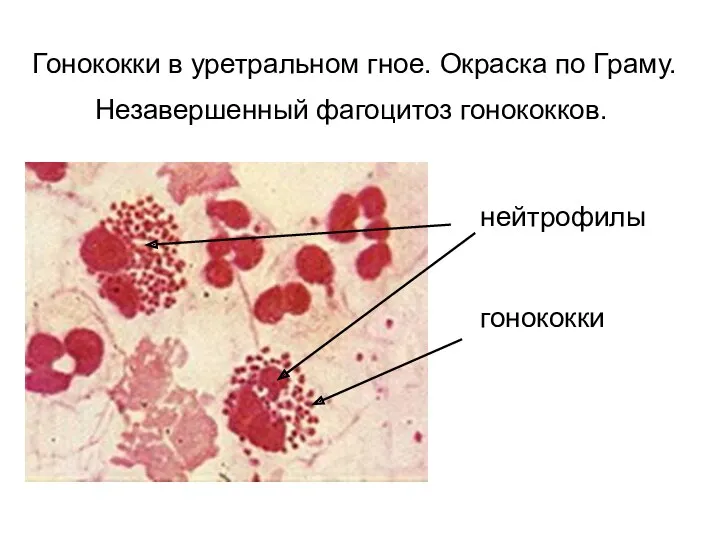 Гонококки в уретральном гное. Окраска по Граму. Незавершенный фагоцитоз гонококков. нейтрофилы гонококки