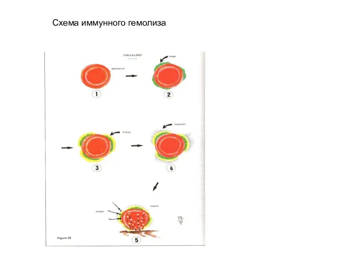Схема иммунного гемолиза