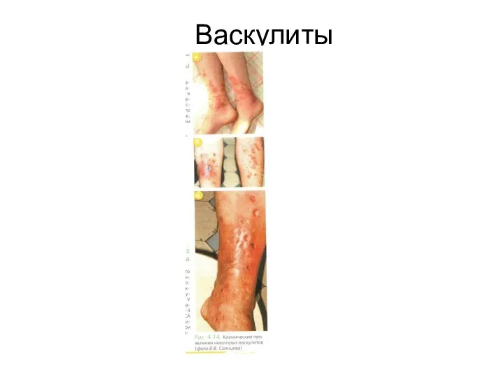 Васкулиты