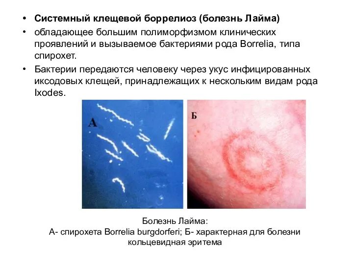 Системный клещевой боррелиоз (болезнь Лайма) обладающее большим полиморфизмом клинических проявлений и вызываемое бактериями