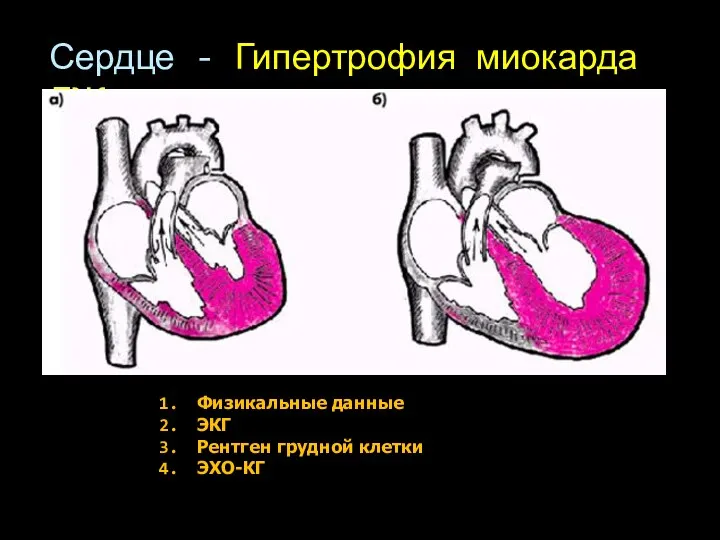 Сердце - Гипертрофия миокарда ЛЖ Физикальные данные ЭКГ Рентген грудной клетки ЭХО-КГ