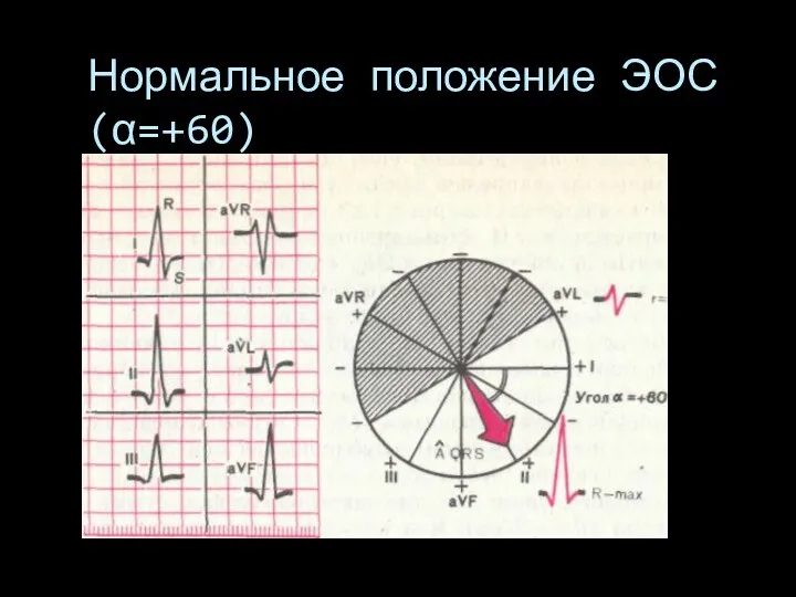 Нормальное положение ЭОС (α=+60)