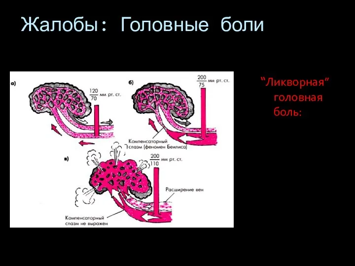 Жалобы: Головные боли “Ликворная” головная боль: