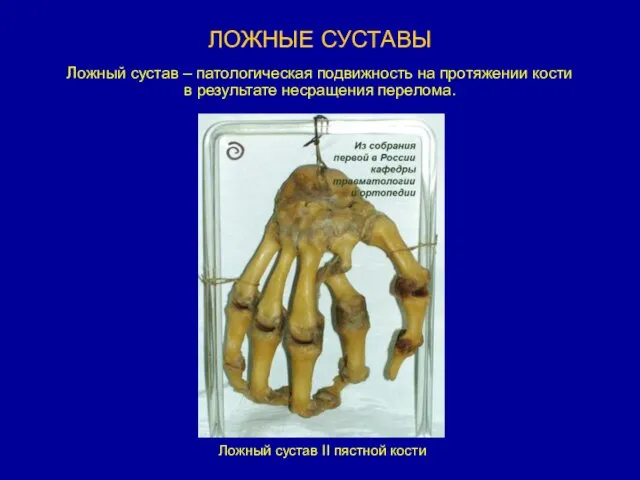 ЛОЖНЫЕ СУСТАВЫ Ложный сустав II пястной кости Ложный сустав –