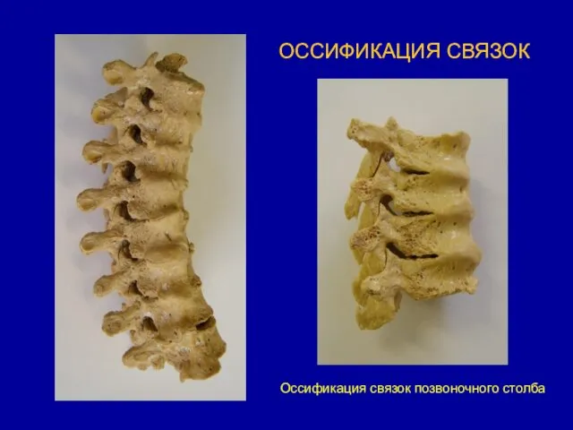 ОССИФИКАЦИЯ СВЯЗОК Оссификация связок позвоночного столба