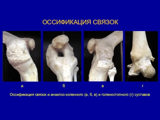 ОССИФИКАЦИЯ СВЯЗОК Оссификация связок и анкилоз коленного (а, б, в)