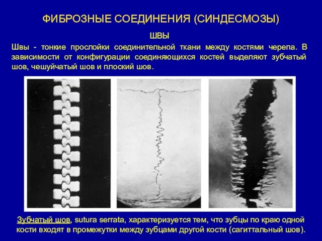 ФИБРОЗНЫЕ СОЕДИНЕНИЯ (СИНДЕСМОЗЫ) Зубчатый шов, sutura serrata, характеризуется тем, что