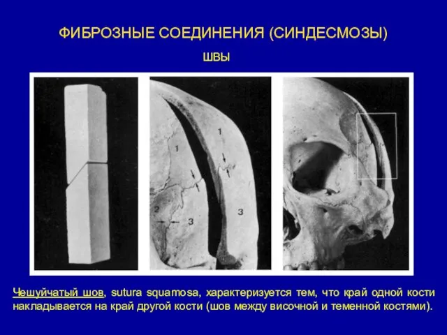 ФИБРОЗНЫЕ СОЕДИНЕНИЯ (СИНДЕСМОЗЫ) Чешуйчатый шов, sutura squamosa, характеризуется тем, что