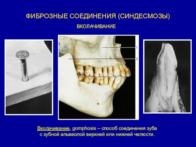 ФИБРОЗНЫЕ СОЕДИНЕНИЯ (СИНДЕСМОЗЫ) Вколачивание, gomphosis – способ соединения зуба с