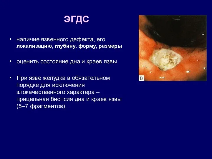 ЭГДС наличие язвенного дефекта, его локализацию, глубину, форму, размеры оценить