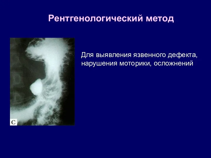 Рентгенологический метод Для выявления язвенного дефекта, нарушения моторики, осложнений