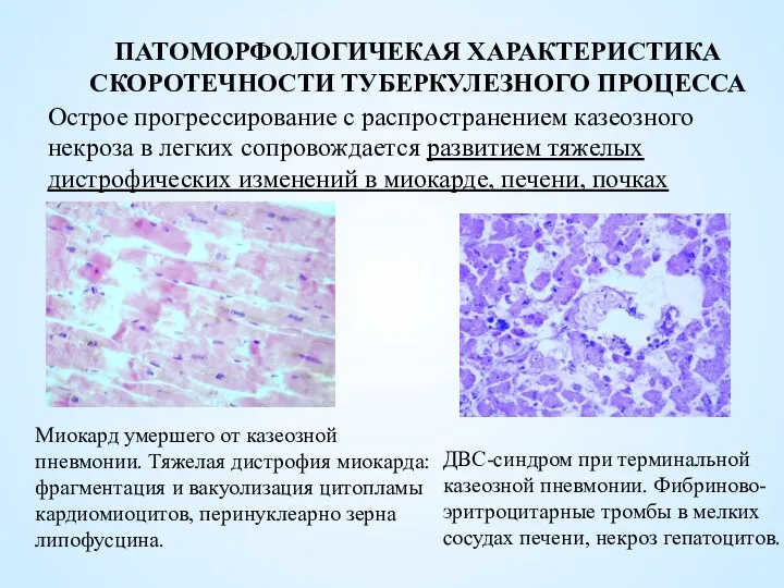 ПАТОМОРФОЛОГИЧЕКАЯ ХАРАКТЕРИСТИКА СКОРОТЕЧНОСТИ ТУБЕРКУЛЕЗНОГО ПРОЦЕССА ДВС-синдром при терминальной казеозной пневмонии.