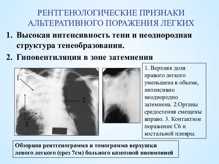 РЕНТГЕНОЛОГИЧЕСКИЕ ПРИЗНАКИ АЛЬТЕРАТИВНОГО ПОРАЖЕНИЯ ЛЕГКИХ Высокая интенсивность тени и неоднородная