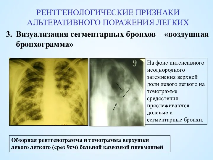 РЕНТГЕНОЛОГИЧЕСКИЕ ПРИЗНАКИ АЛЬТЕРАТИВНОГО ПОРАЖЕНИЯ ЛЕГКИХ Визуализация сегментарных бронхов – «воздушная