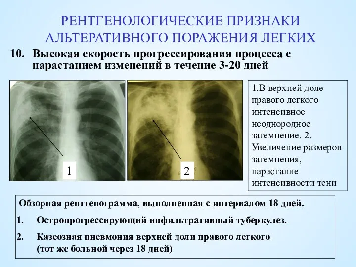 РЕНТГЕНОЛОГИЧЕСКИЕ ПРИЗНАКИ АЛЬТЕРАТИВНОГО ПОРАЖЕНИЯ ЛЕГКИХ Высокая скорость прогрессирования процесса с