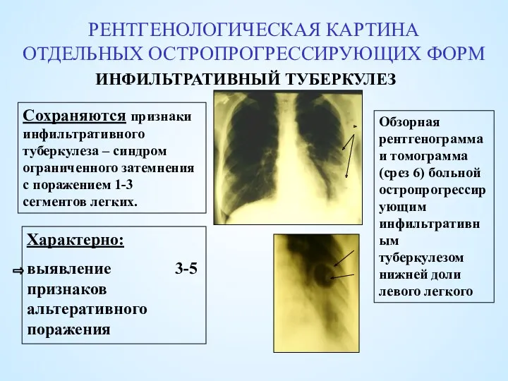 РЕНТГЕНОЛОГИЧЕСКАЯ КАРТИНА ОТДЕЛЬНЫХ ОСТРОПРОГРЕССИРУЮЩИХ ФОРМ ИНФИЛЬТРАТИВНЫЙ ТУБЕРКУЛЕЗ Сохраняются признаки инфильтративного