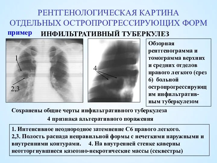 РЕНТГЕНОЛОГИЧЕСКАЯ КАРТИНА ОТДЕЛЬНЫХ ОСТРОПРОГРЕССИРУЮЩИХ ФОРМ ИНФИЛЬТРАТИВНЫЙ ТУБЕРКУЛЕЗ Обзорная рентгенограмма и