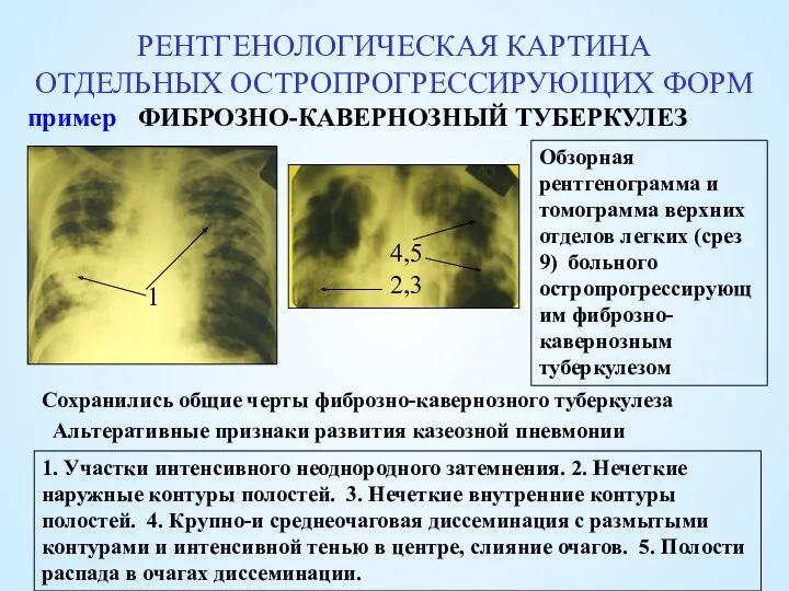 РЕНТГЕНОЛОГИЧЕСКАЯ КАРТИНА ОТДЕЛЬНЫХ ОСТРОПРОГРЕССИРУЮЩИХ ФОРМ ФИБРОЗНО-КАВЕРНОЗНЫЙ ТУБЕРКУЛЕЗ Обзорная рентгенограмма и