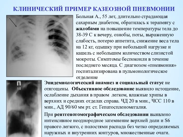 КЛИНИЧЕСКИЙ ПРИМЕР КАЗЕОЗНОЙ ПНЕВМОНИИ Больная А., 55 лет, длительно страдающая