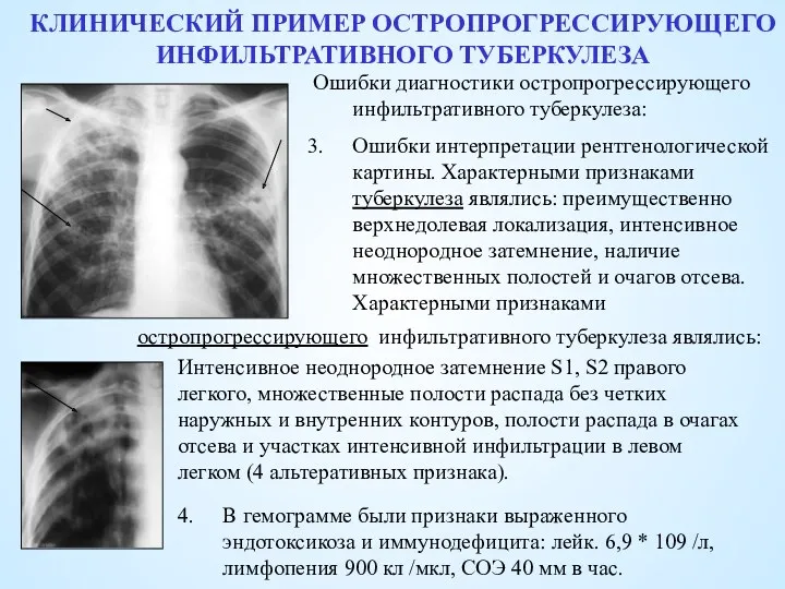 КЛИНИЧЕСКИЙ ПРИМЕР ОСТРОПРОГРЕССИРУЮЩЕГО ИНФИЛЬТРАТИВНОГО ТУБЕРКУЛЕЗА Ошибки диагностики остропрогрессирующего инфильтративного туберкулеза: