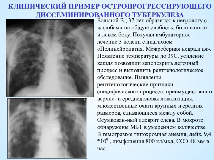 КЛИНИЧЕСКИЙ ПРИМЕР ОСТРОПРОГРЕССИРУЮЩЕГО ДИССЕМИНИРОВАННОГО ТУБЕРКУЛЕЗА Больной В., 37 лет обратился