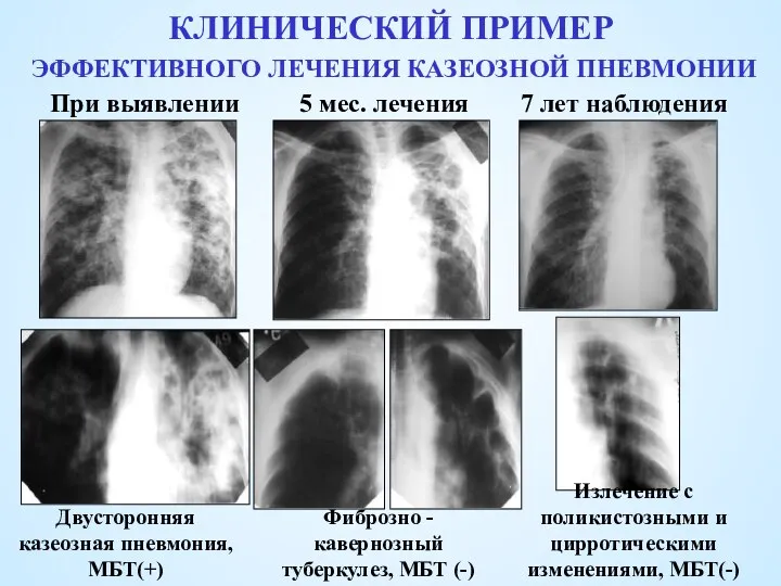 КЛИНИЧЕСКИЙ ПРИМЕР ЭФФЕКТИВНОГО ЛЕЧЕНИЯ КАЗЕОЗНОЙ ПНЕВМОНИИ При выявлении 5 мес.