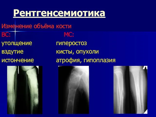 Рентгенсемиотика Изменение объёма кости ВС: МС: утолщение гиперостоз вздутие кисты, опухоли истончение атрофия, гипоплазия