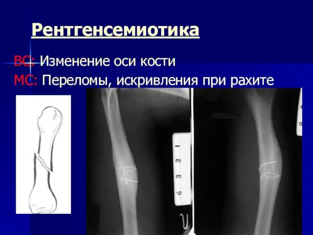 Рентгенсемиотика ВС: Изменение оси кости МС: Переломы, искривления при рахите