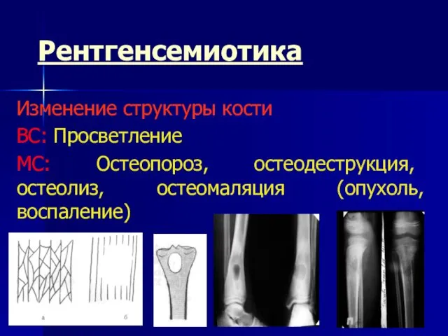 Рентгенсемиотика Изменение структуры кости ВС: Просветление МС: Остеопороз, остеодеструкция, остеолиз, остеомаляция (опухоль, воспаление)