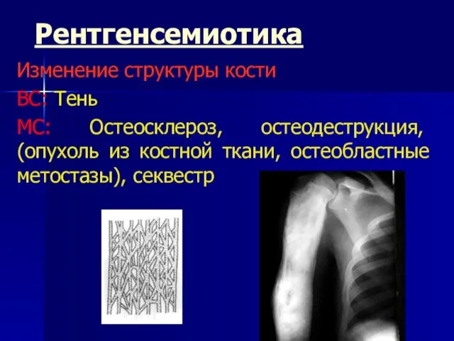 Рентгенсемиотика Изменение структуры кости ВС: Тень МС: Остеосклероз, остеодеструкция, (опухоль из костной ткани, остеобластные метостазы), секвестр