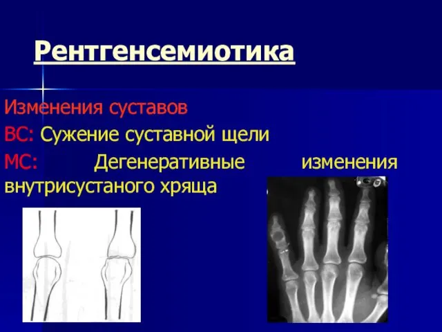 Рентгенсемиотика Изменения суставов ВС: Сужение суставной щели МС: Дегенеративные изменения внутрисустаного хряща