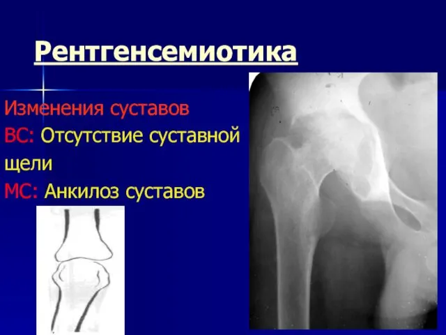 Рентгенсемиотика Изменения суставов ВС: Отсутствие суставной щели МС: Анкилоз суставов