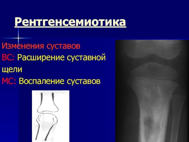 Рентгенсемиотика Изменения суставов ВС: Расширение суставной щели МС: Воспаление суставов