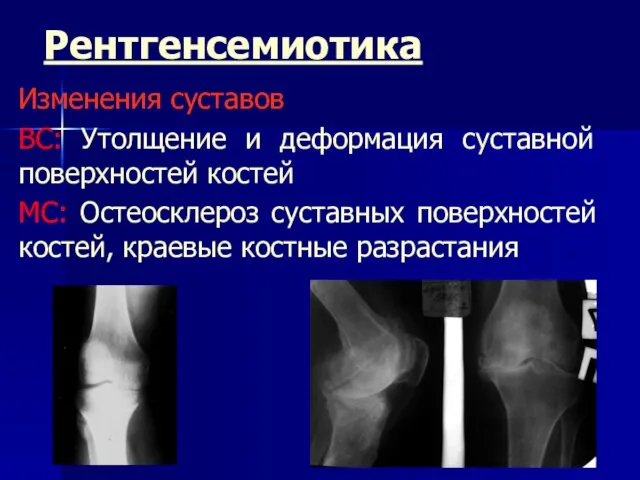Рентгенсемиотика Изменения суставов ВС: Утолщение и деформация суставной поверхностей костей