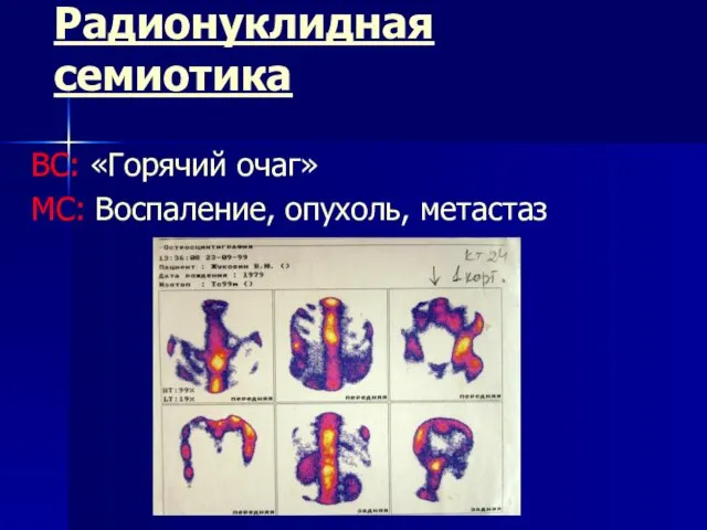 Радионуклидная семиотика ВС: «Горячий очаг» МС: Воспаление, опухоль, метастаз