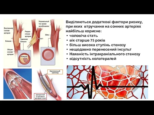 Виділяються додаткові фактори ризику, при яких втручання на сонних артеріях