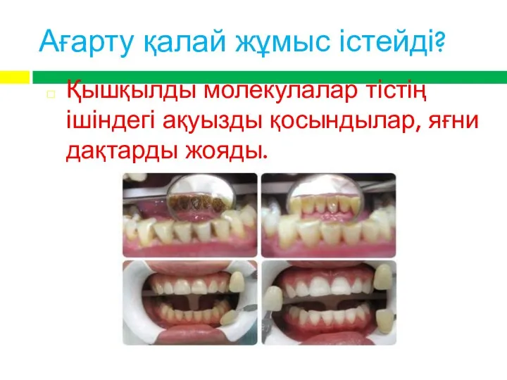 Ағарту қалай жұмыс істейді? Қышқылды молекулалар тістің ішіндегі ақуызды қосындылар, яғни дақтарды жояды.