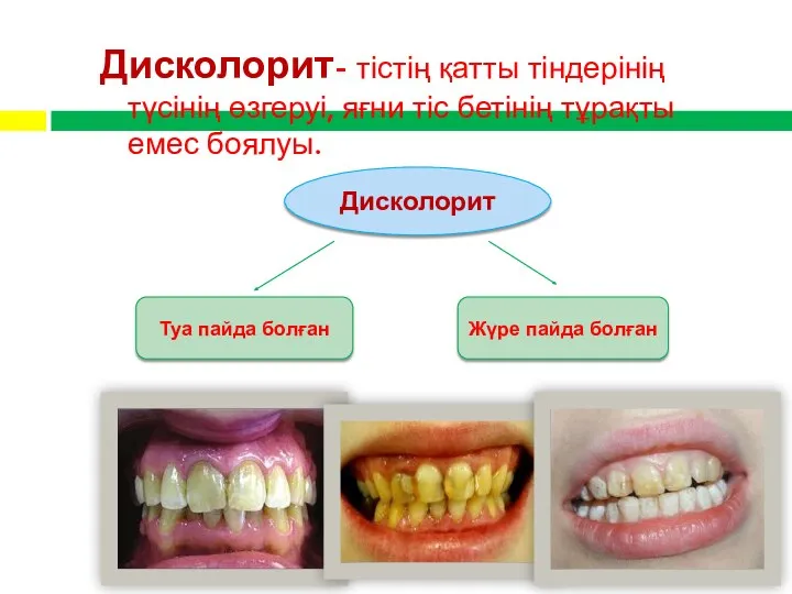 Дисколорит- тістің қатты тіндерінің түсінің өзгеруі, яғни тіс бетінің тұрақты