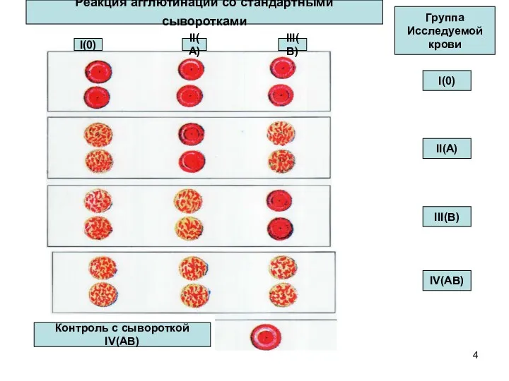 Реакция агглютинации со стандартными сыворотками I(0) II(A) III(B) Группа Исследуемой крови I(0) II(A)