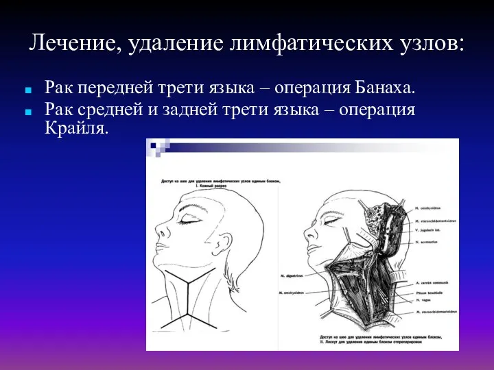 Лечение, удаление лимфатических узлов: Рак передней трети языка – операция