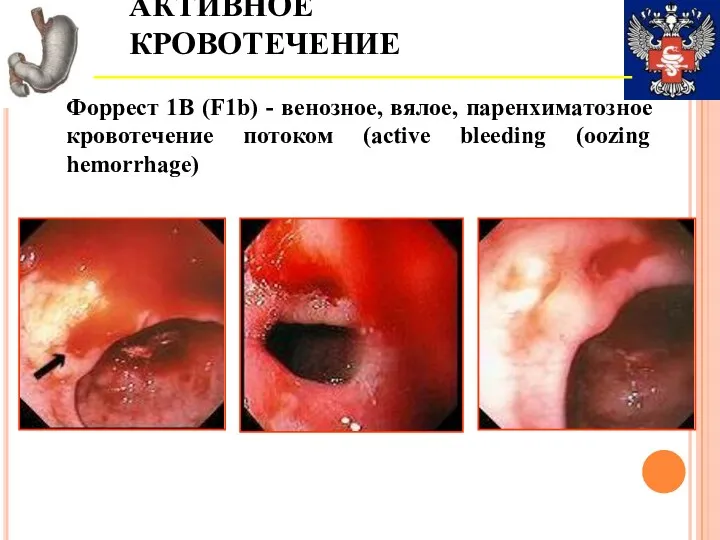 АКТИВНОЕ КРОВОТЕЧЕНИЕ Форрест 1В (F1b) - венозное, вялое, паренхиматозное кровотечение потоком (active bleeding (oozing hemorrhage)