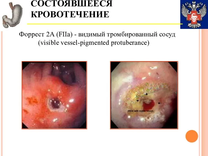 СОСТОЯВШЕЕСЯ КРОВОТЕЧЕНИЕ Форрест 2А (FIIa) - видимый тромбированный сосуд (visible vessel-pigmented protuberance)