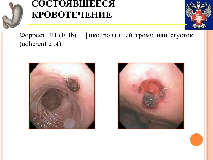 СОСТОЯВШЕЕСЯ КРОВОТЕЧЕНИЕ Форрест 2В (FIIb) - фиксированный тромб или сгусток (adherent clot)