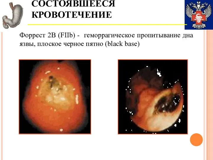 СОСТОЯВШЕЕСЯ КРОВОТЕЧЕНИЕ Форрест 2В (FIIb) - геморрагическое пропитывание дна язвы, плоское черное пятно (black base)