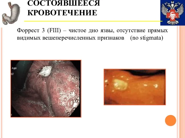 СОСТОЯВШЕЕСЯ КРОВОТЕЧЕНИЕ Форрест 3 (FIII) – чистое дно язвы, отсутствие прямых видимых вешеперечисленных признаков (no stigmata)