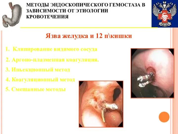 МЕТОДЫ ЭНДОСКОПИЧЕСКОГО ГЕМОСТАЗА В ЗАВИСИМОСТИ ОТ ЭТИОЛОГИИ КРОВОТЕЧЕНИЯ Язва желудка