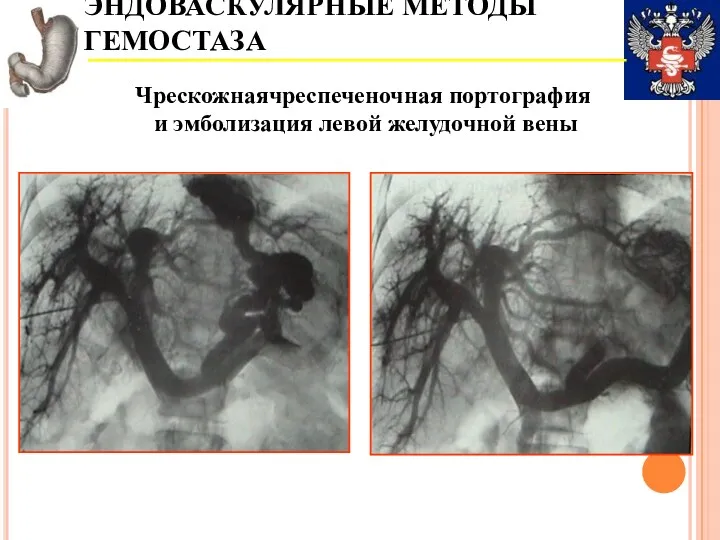 ЭНДОВАСКУЛЯРНЫЕ МЕТОДЫ ГЕМОСТАЗА Чрескожнаячреспеченочная портография и эмболизация левой желудочной вены