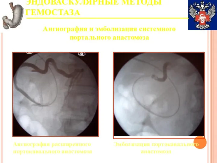 ЭНДОВАСКУЛЯРНЫЕ МЕТОДЫ ГЕМОСТАЗА Ангиография и эмболизация системного портального анастомоза Ангиография расширенного портокавального анастомоза Эмболизация портокавального анастомоза