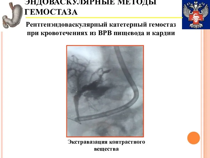 ЭНДОВАСКУЛЯРНЫЕ МЕТОДЫ ГЕМОСТАЗА Рентгенэндоваскулярный катетерный гемостаз при кровотечениях из ВРВ пищевода и кардии Экстравазация контрастного вещества