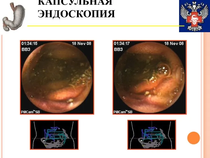 КАПСУЛЬНАЯ ЭНДОСКОПИЯ